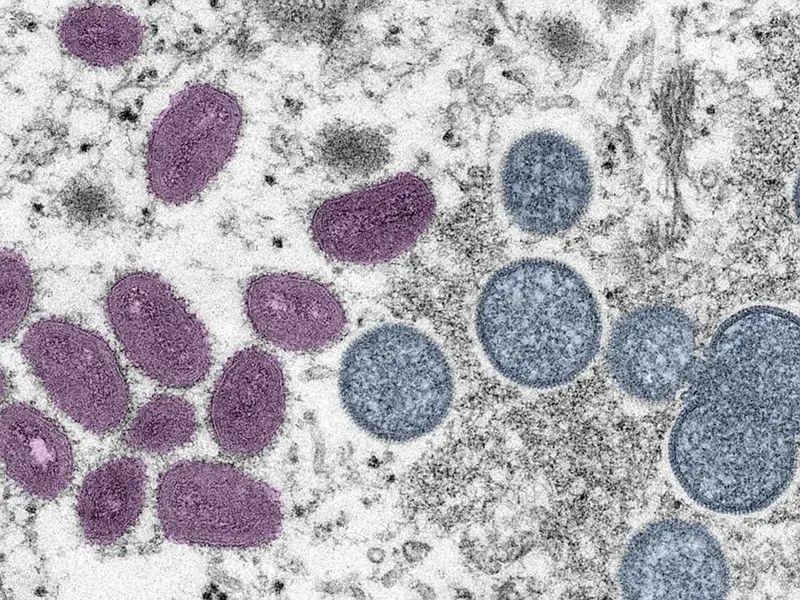 荷兰发现首例儿童感染猴痘病毒，卫生部表示密接者无需隔离