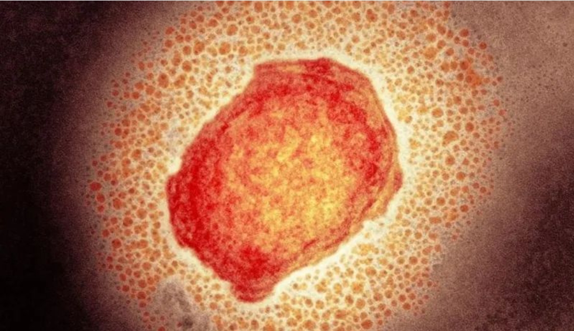 荷兰最新猴痘感染数据公布，累计656人，其中包括三名女性